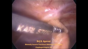 Laparoscopic Surgery for Abdominal Wall Hernia