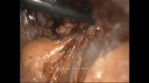 Endoscopic Varicocele Surgery for Male Infertility