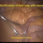 Gallstone Ileus – Very Rare Complication of Gallbladder