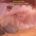 Technique Of Irreducible Inguinal Hernia Repair By Totally Extra Peritoneal Approach