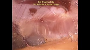Technique Of Irreducible Inguinal Hernia Repair By Totally Extra Peritoneal Approach