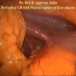 Laparoscopic Cholecystectomy Without Energised Dissection For Perforated Empyema Gall Bladder With Contiguous Liver Abscess With Rupture Into The Pleural Cavity