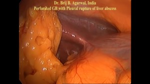 Laparoscopic Cholecystectomy Without Energised Dissection For Perforated Empyema Gall Bladder With Contiguous Liver Abscess With Rupture Into The Pleural Cavity