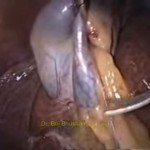 Laparoscopic Cholecystectomy without using any energy source