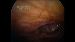 Laparoscopic Mayo's Repair with Meshplasty for Ventral Hernia