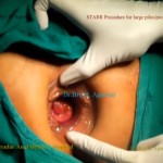 STARR Procedure (Stapled Transanal Resection of the Rectum)