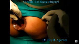 Stapled Trans Anal Rectal Resection For A Post-Stapled Hemorrhoidopexy Stricture