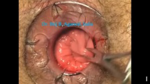 Stapled Trans Anal Rectal Resection (STARR) For Obstructed Defecation Syndrome (ODS)