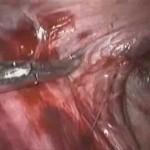 TEP Inguinal Hernia Endoscopic Surgery