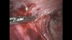 TEP Inguinal Hernia Endoscopic Surgery