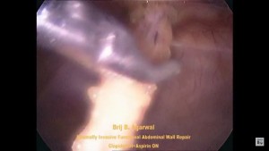 MINIMALLY INVASIVE FUNCTIONAL REPAIR OF THE ABDOMINAL WALL IN MULTIPLE/TROCAR SITE VENTRAL HERNIAS