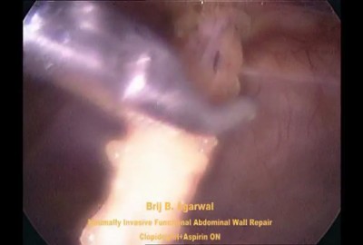 MINIMALLY INVASIVE FUNCTIONAL REPAIR OF THE ABDOMINAL WALL IN MULTIPLE/TROCAR SITE VENTRAL HERNIAS